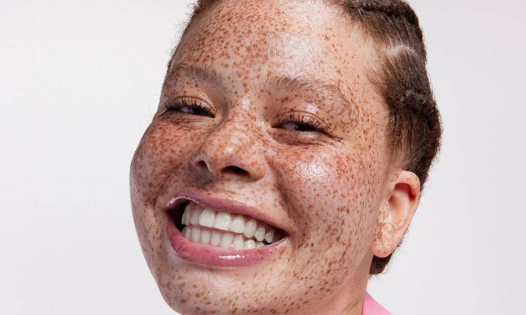 Cómo disimular la hiperpigmentación con maquillaje | L’Oréal Paris